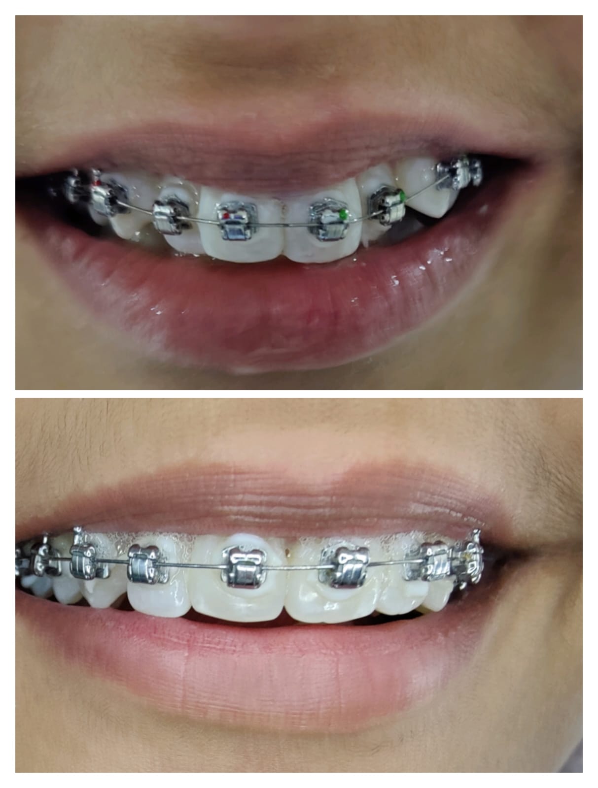 Braces treatment result The Dental Studio Indore