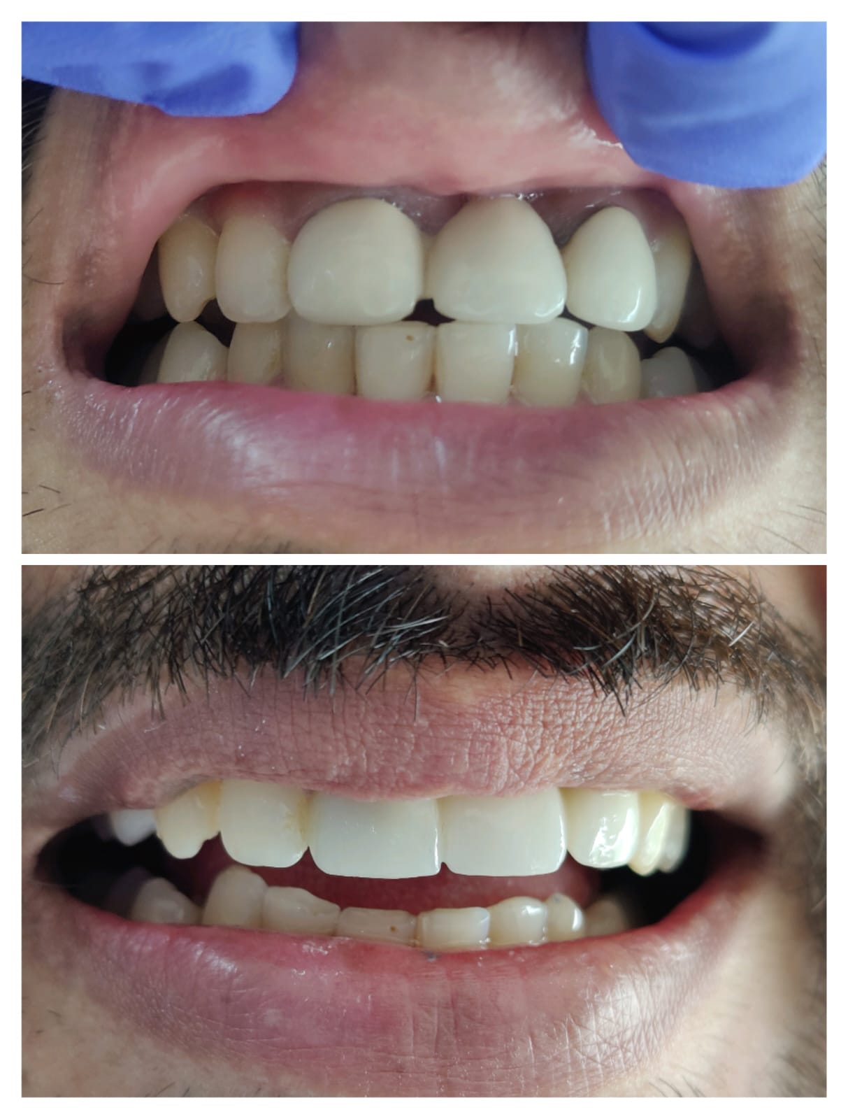 Crown and smile design result The Dental Studio